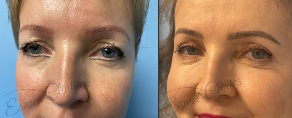 Before and After img